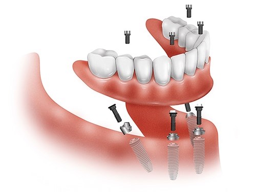 Want A Thriving Business? Focus On dentistry center Dwarka!